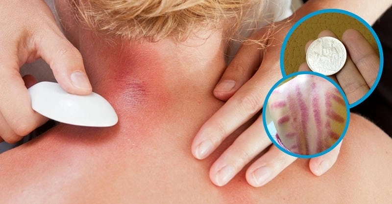  Mẹo cạo gió dân gian với dầu gió, rượu gừng, trứng gà 